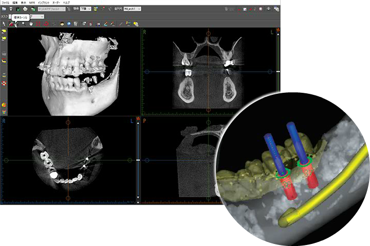 歯科用CT（RevoluX）